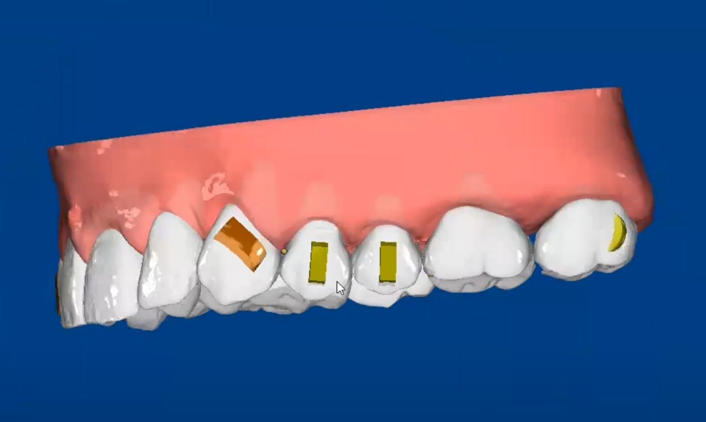 Clear Aligners CAD design – real design case 4