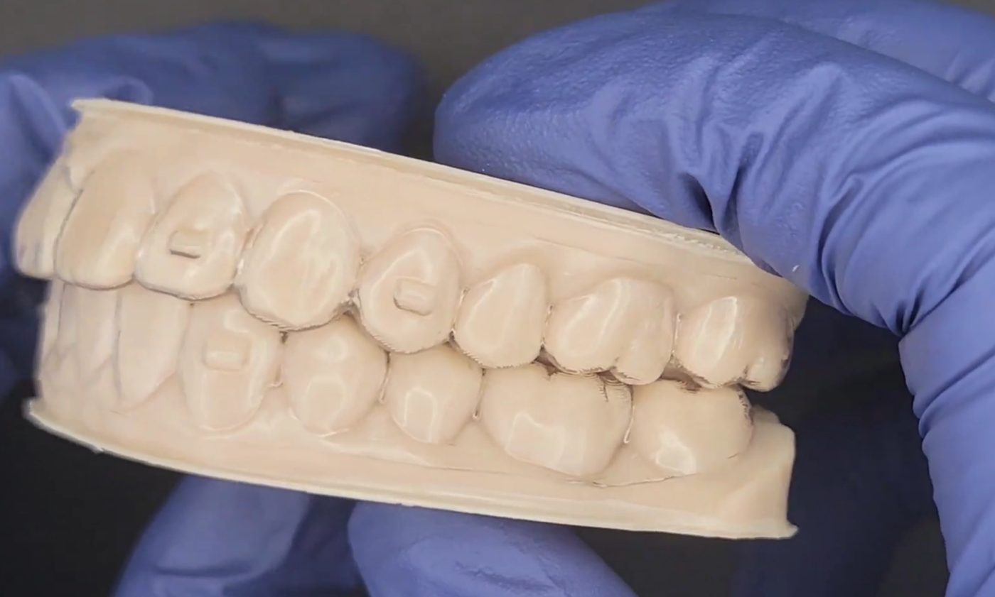 Clear Aligners CAD design – real design case 6