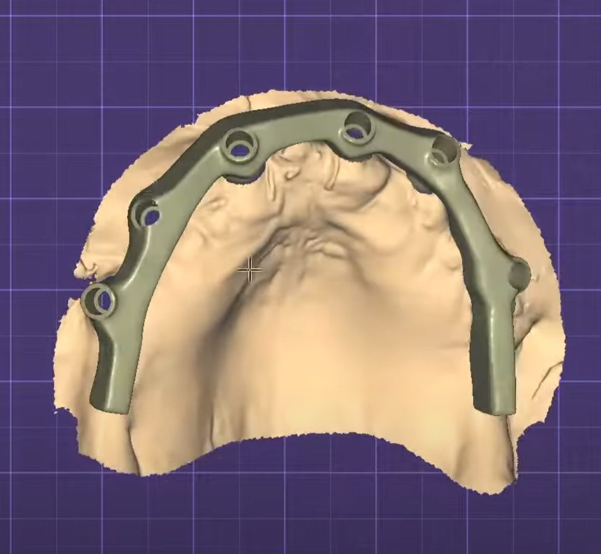 Fit on the model – Implant Bars CAD design