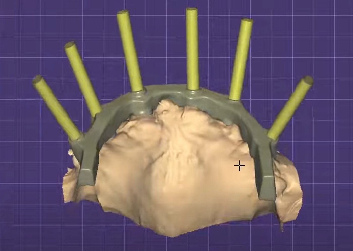 Screw channels on each implant – Implant Bars CAD design