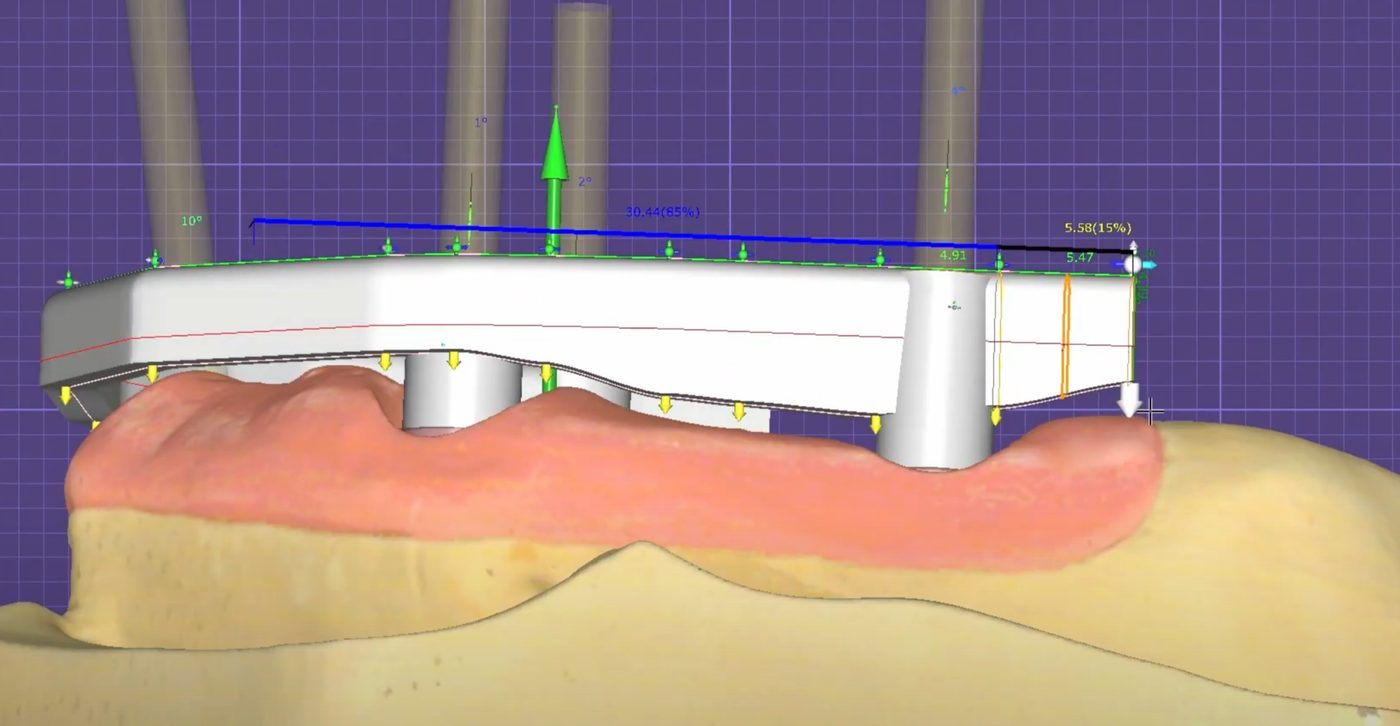 Bar inside the tooth setup – Implant Bars CAD design