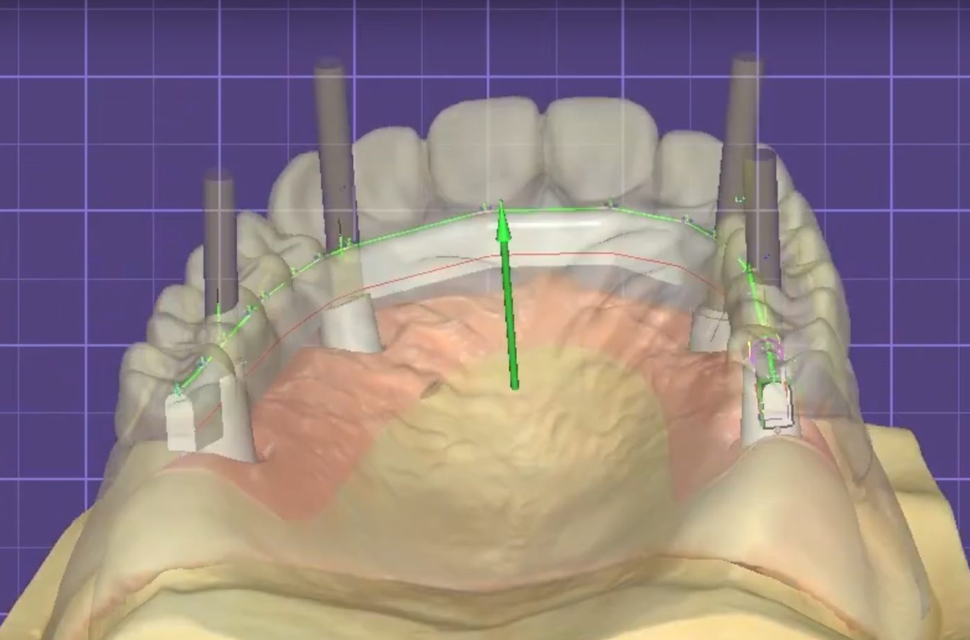 Implant Bars CAD design – real design case 5