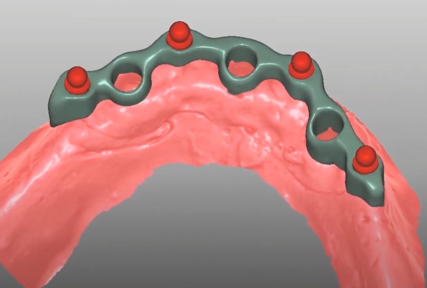 Implant Bars CAD design – real design case 6