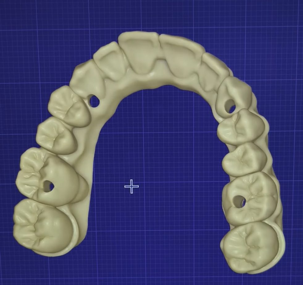 Final full arch CAD design with screw access holes