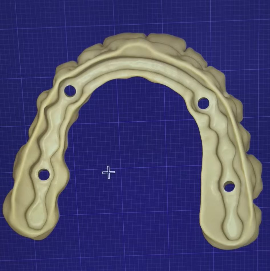 Full arch design with screw channels on each All-on-X implant position