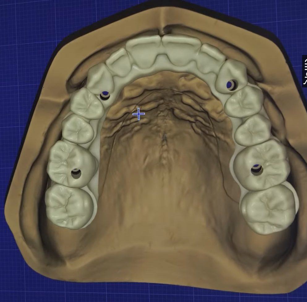 Full arch teeth setup on the scanned model