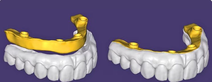 Blender & Full Arch CAD design – real design case 10