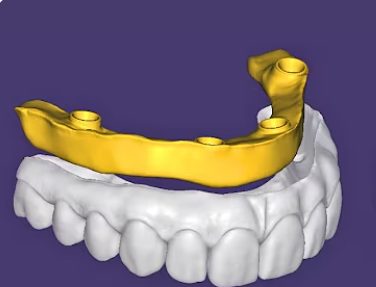 Blender & Full Arch CAD design – real design case 11