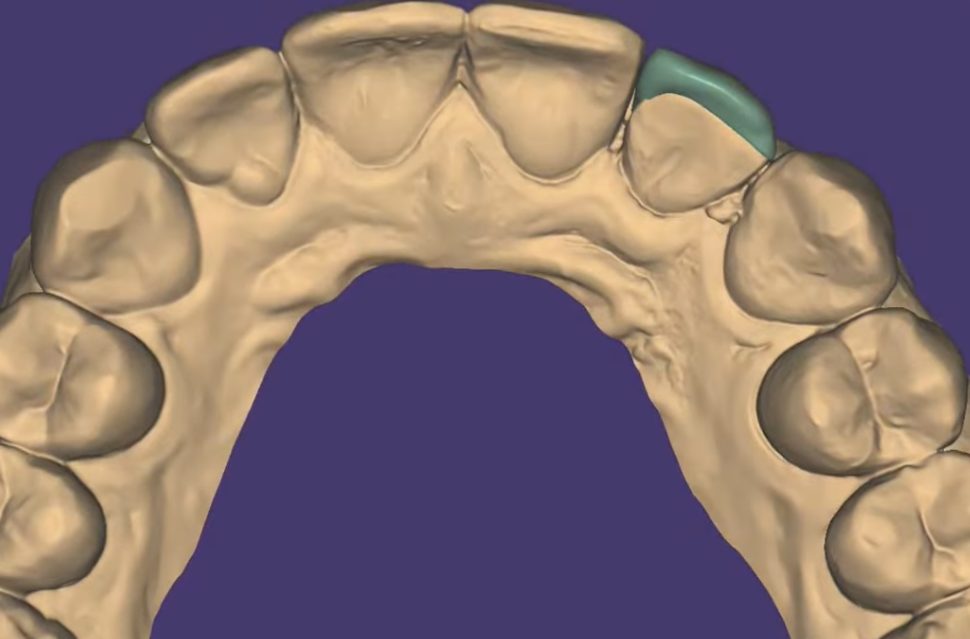 Crowns & Bridges CAD design – real design case 4