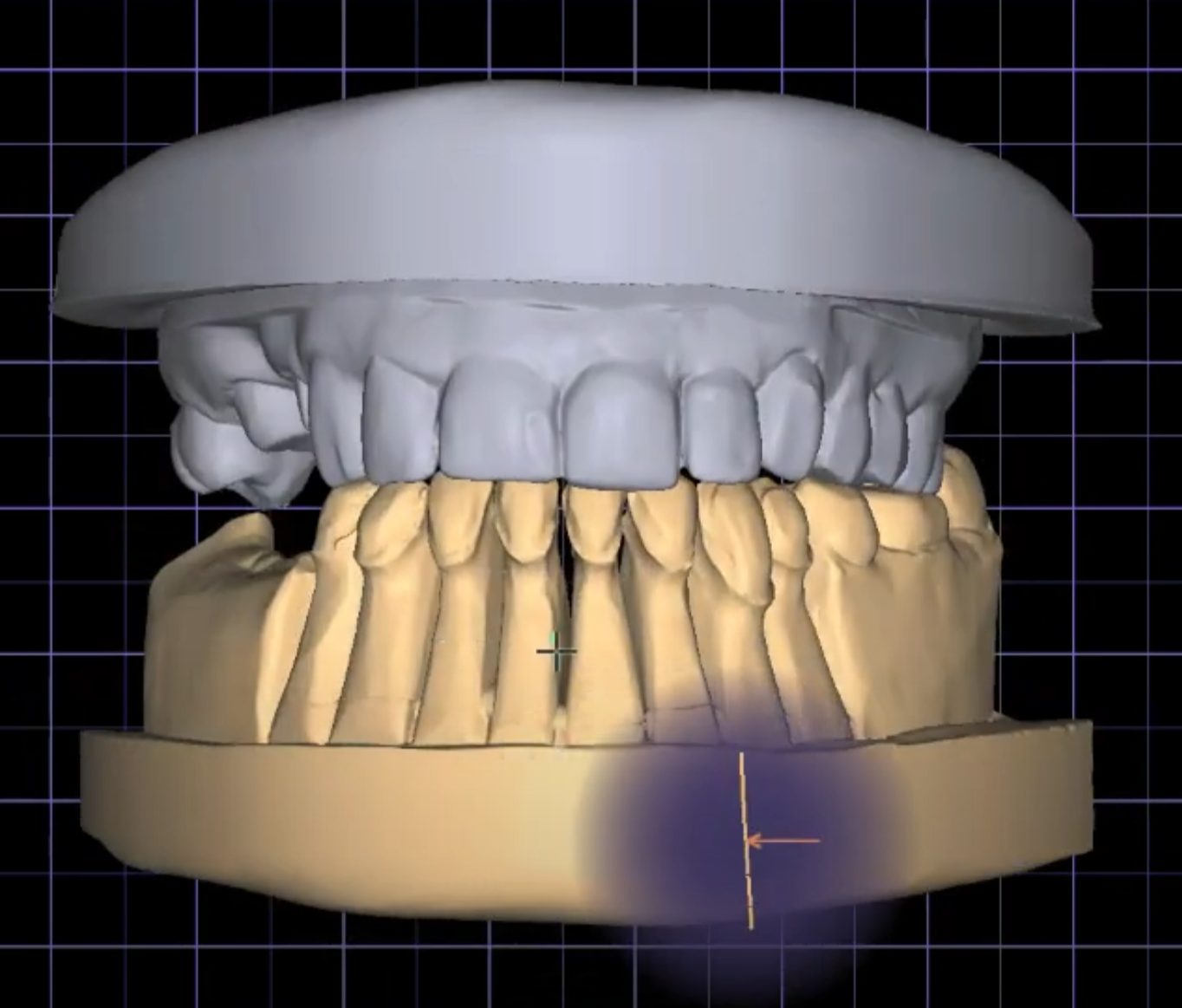 Crowns & Bridges CAD design – real design case 5