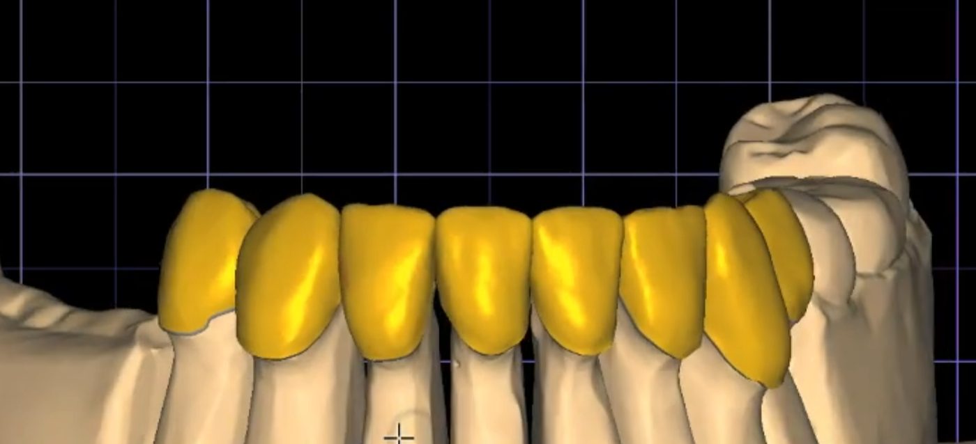 Crowns & Bridges CAD design – real design case 6