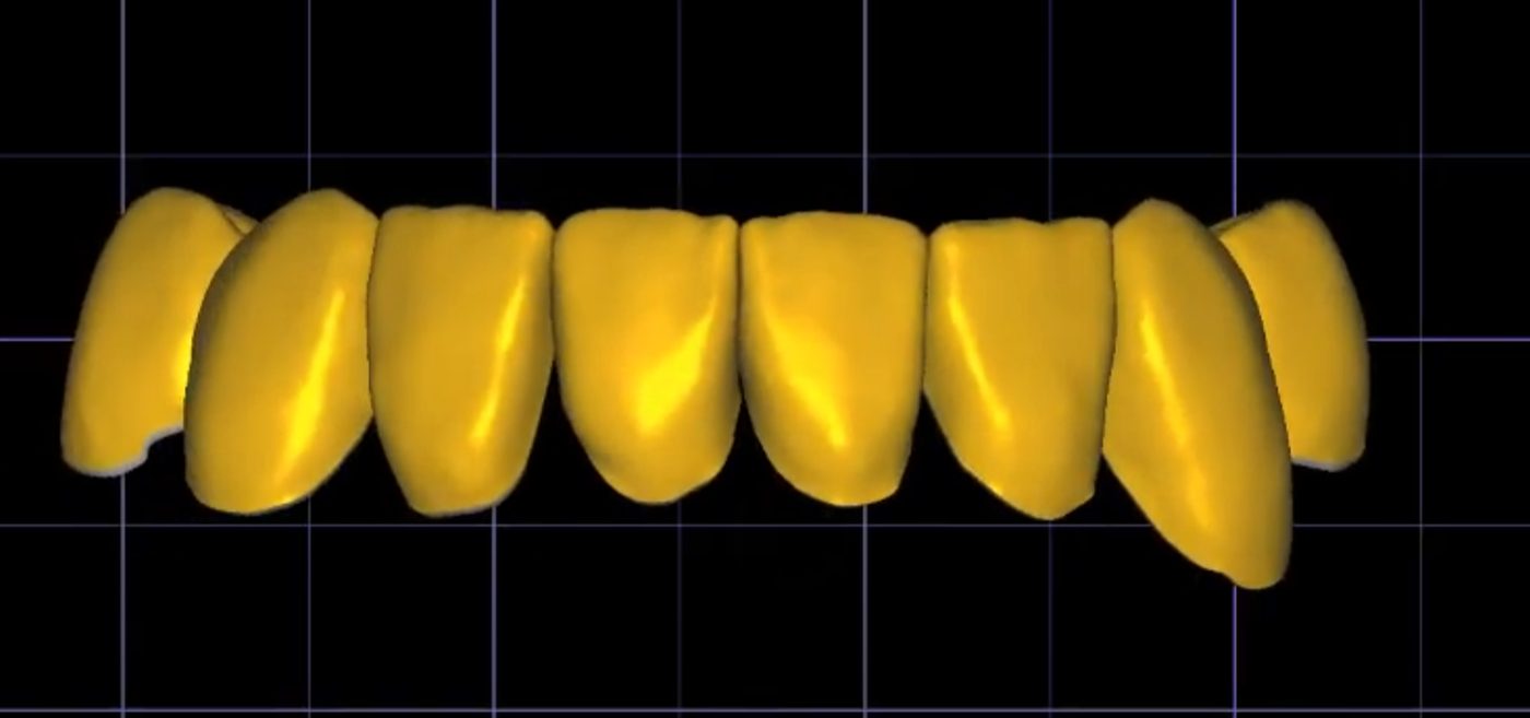 Crowns & Bridges CAD design – real design case 7
