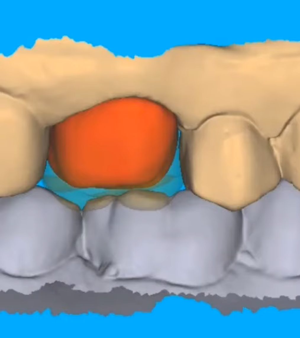 Crowns & Bridges CAD design – real design case 8