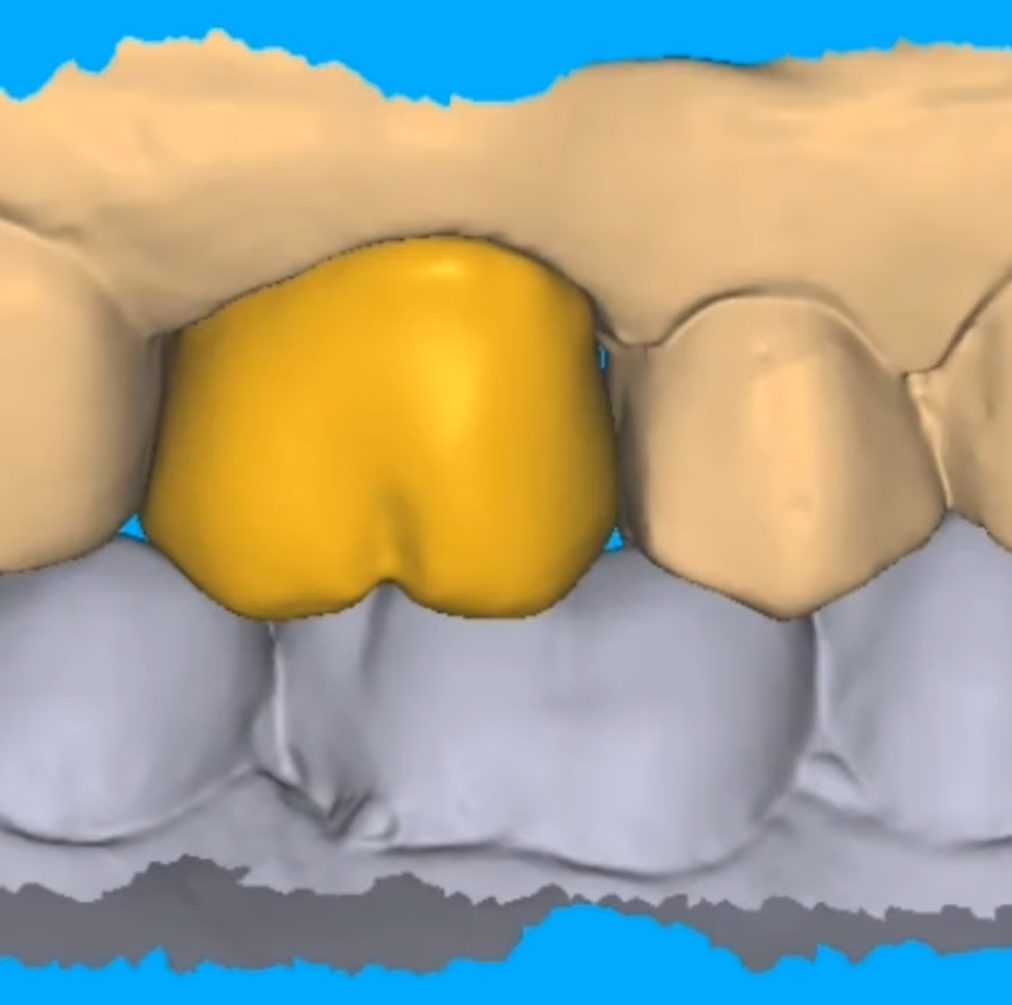 Crowns & Bridges CAD design – real design case 9