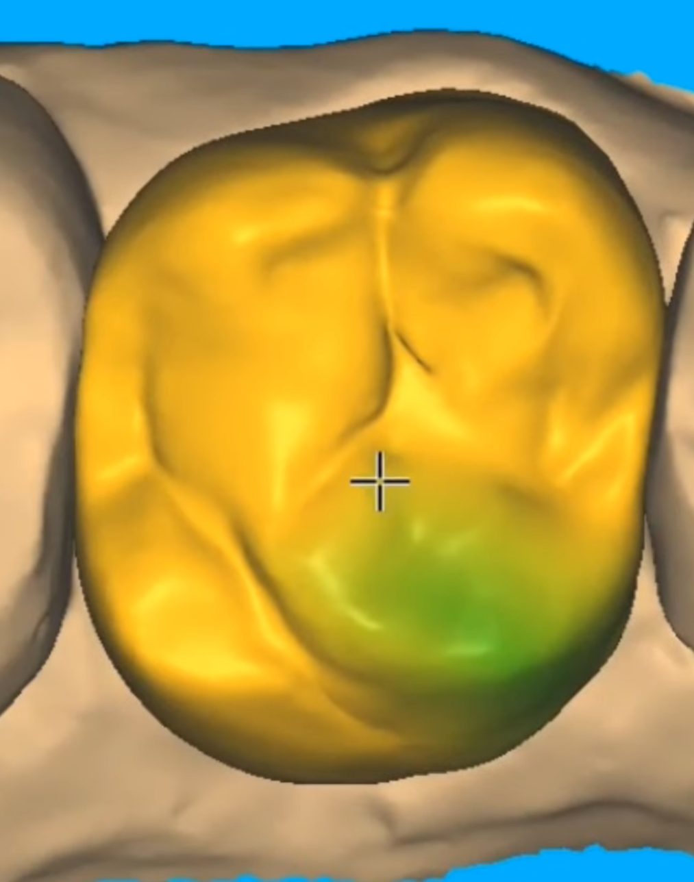 Occlusion checked against the antagonist – Crowns & Bridges CAD design