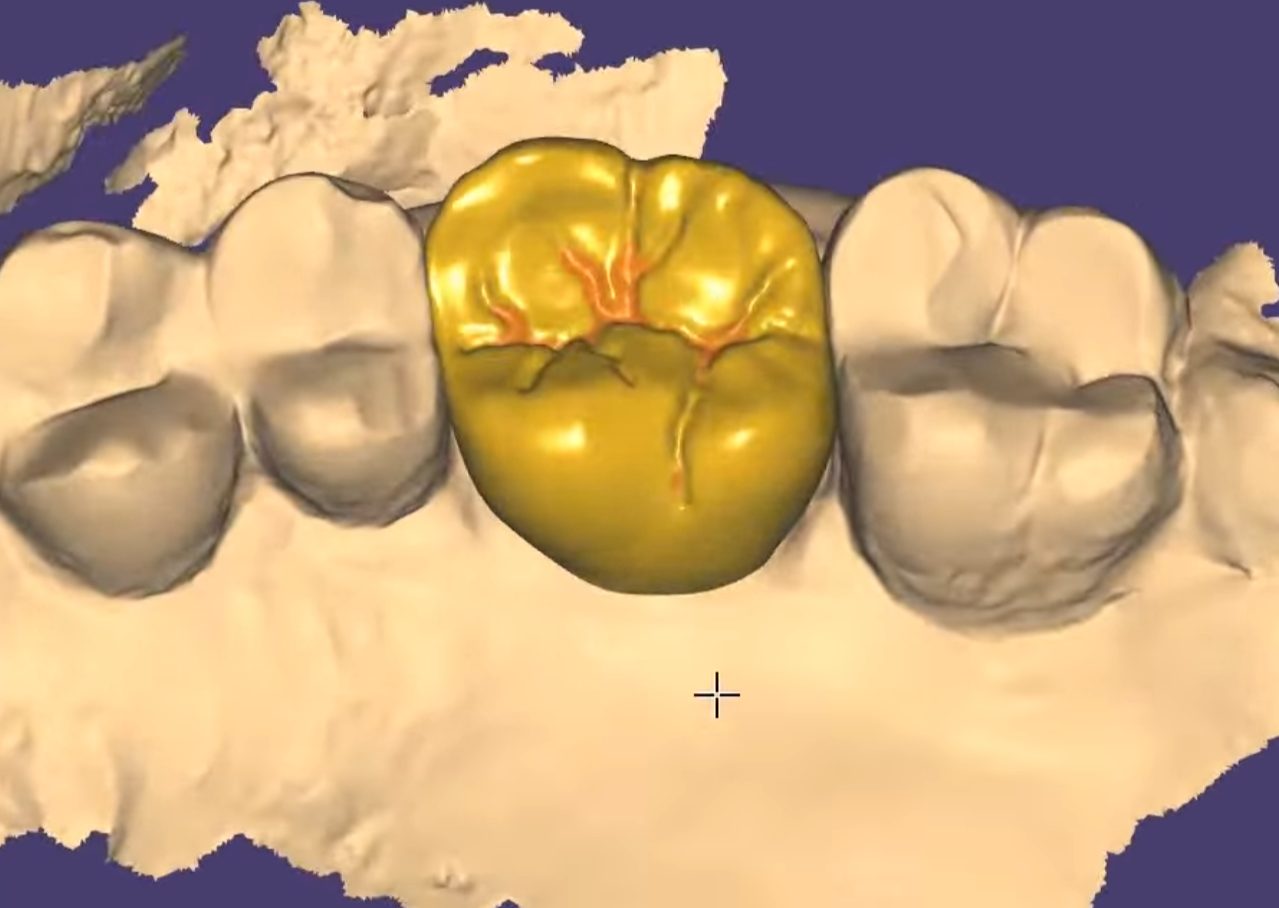 Crowns & Bridges CAD design – real design case 11