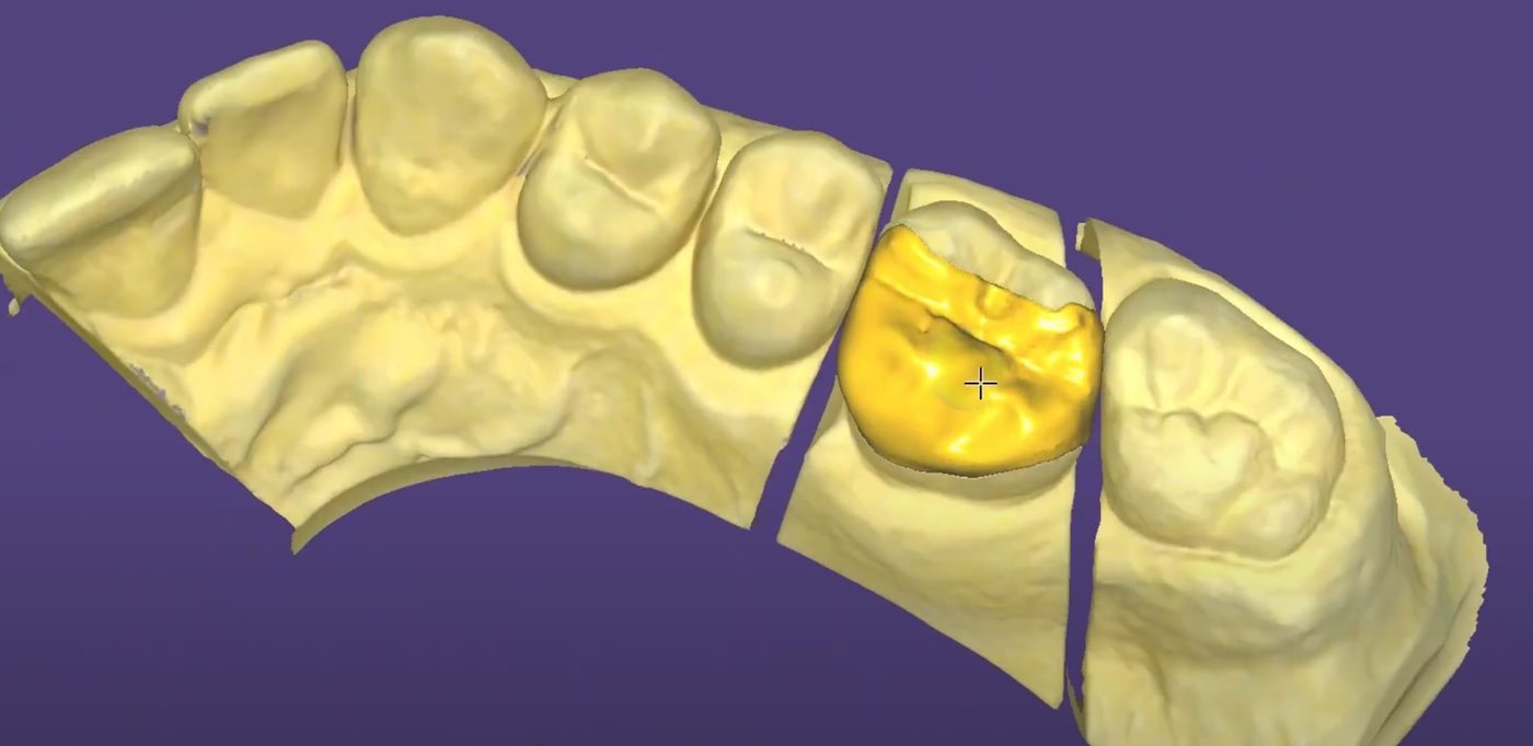 Crowns & Bridges CAD design – real design case 15