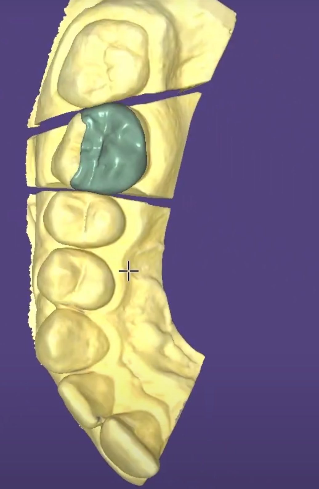 Crowns & Bridges CAD design – real design case 16