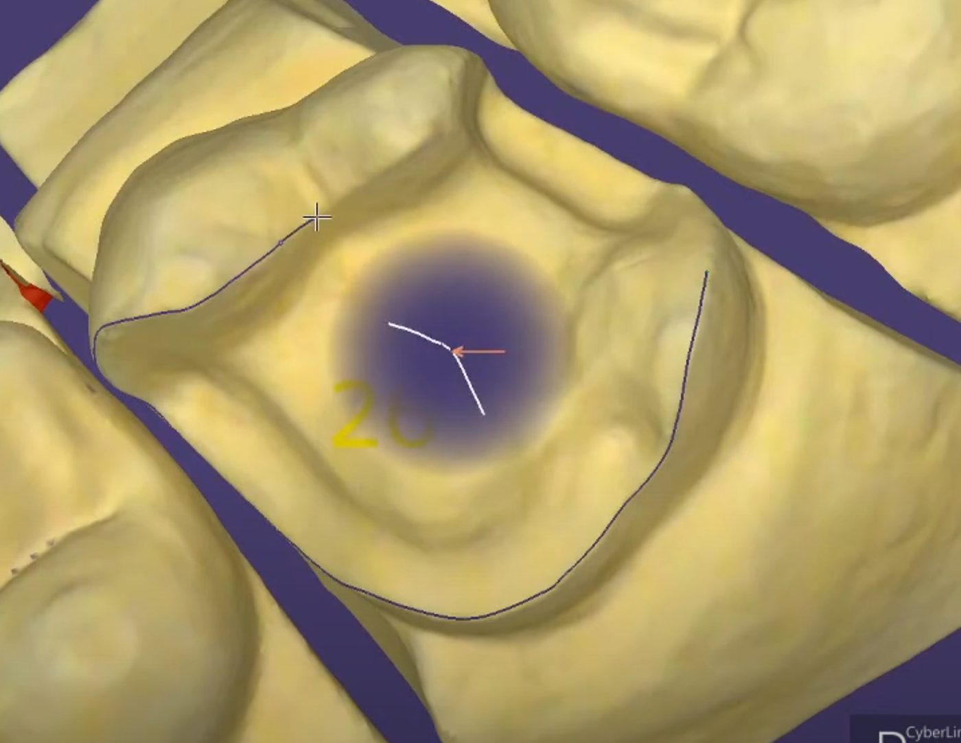 Margin line on the prepared tooth – Crowns & Bridges CAD design