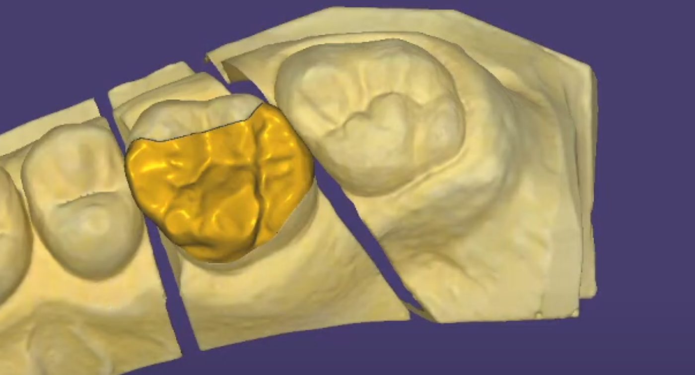 Crown proposal and anatomy – Crowns & Bridges CAD design