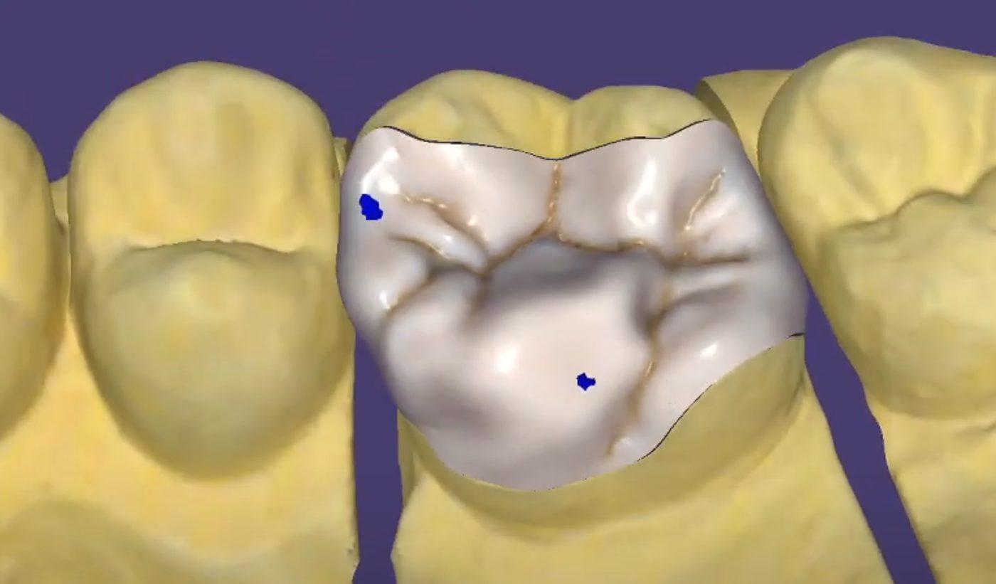 Final design ready for milling – Crowns & Bridges CAD design