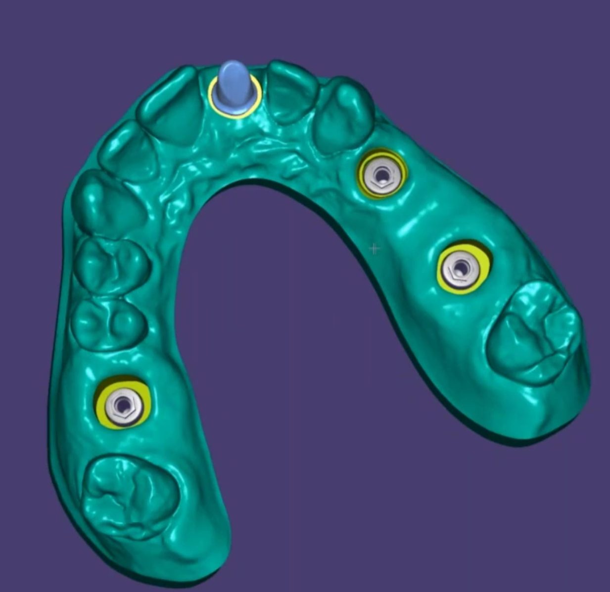 Custom Abutments CAD design – real design case 4
