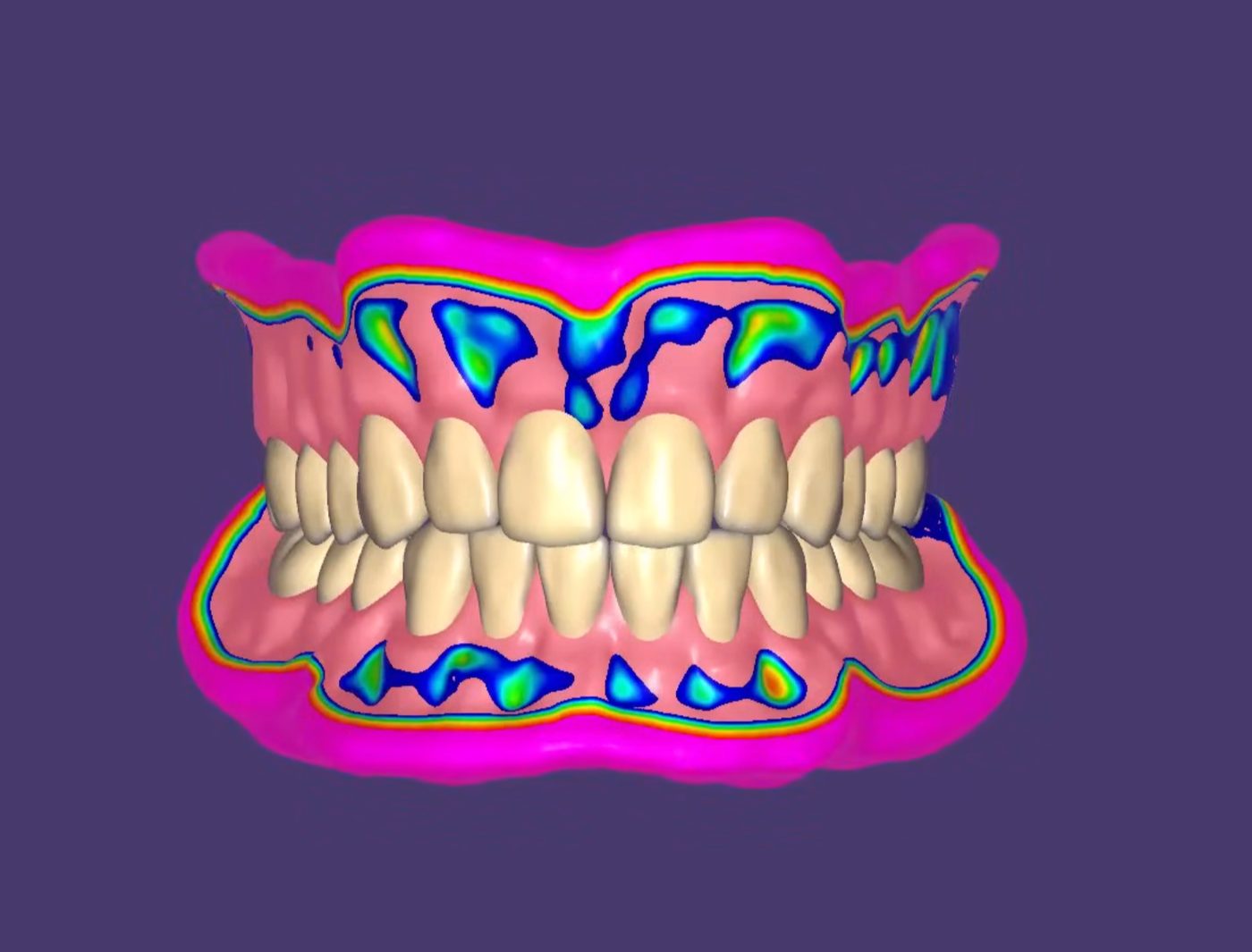 Full Dentures CAD design – real design case 4