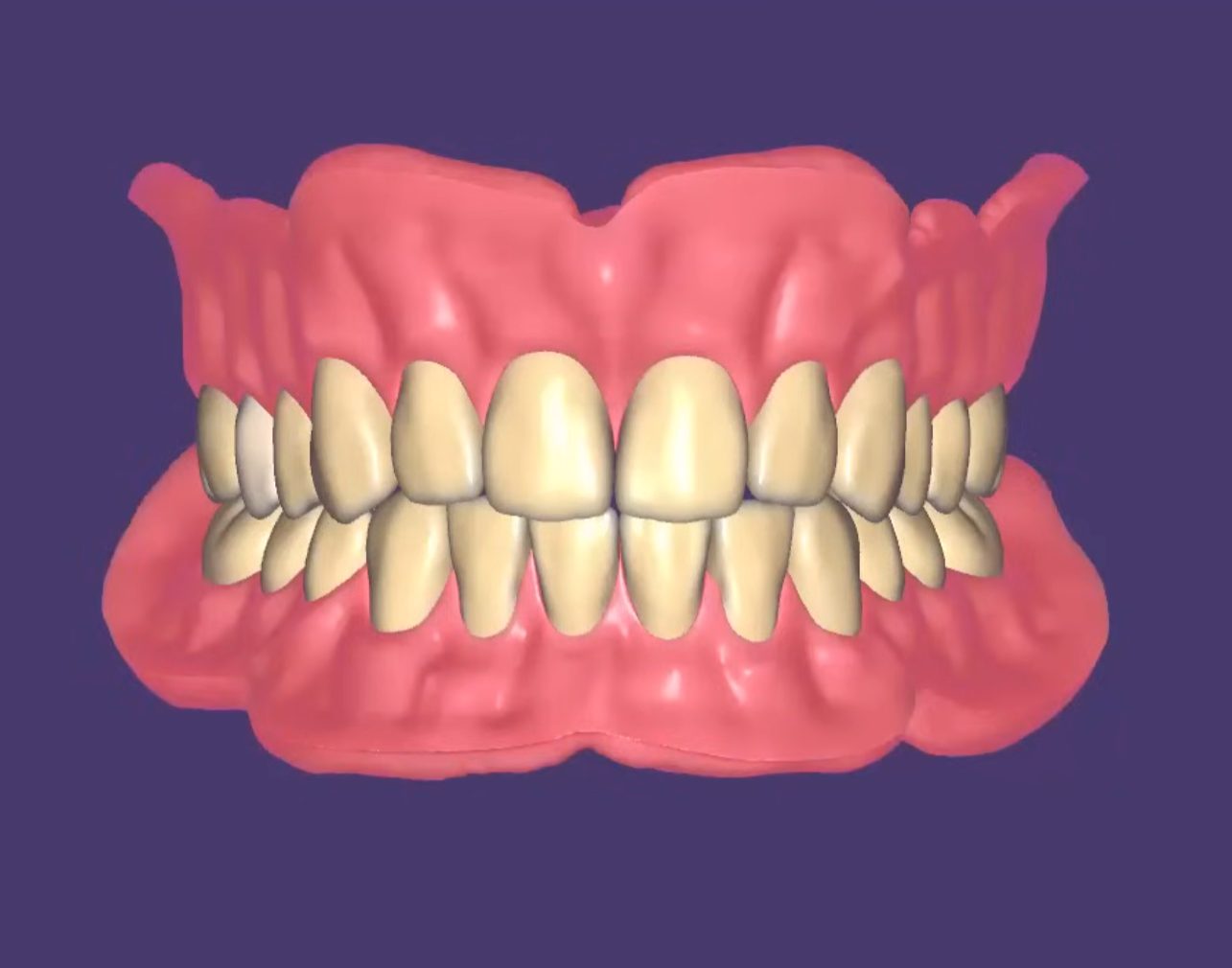 Full Dentures CAD design – real design case 5