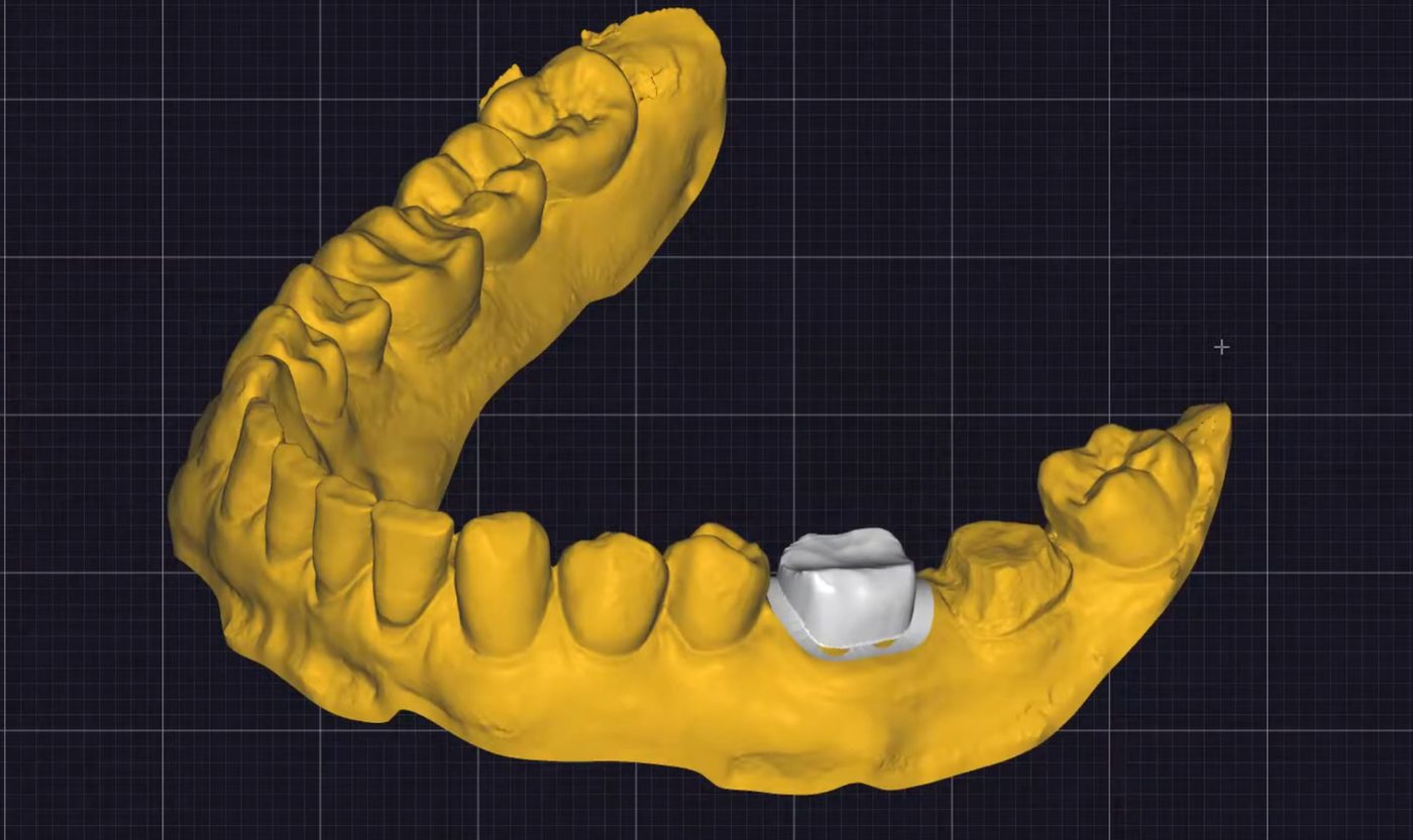 Prepared Teeth CAD design – real design case 4
