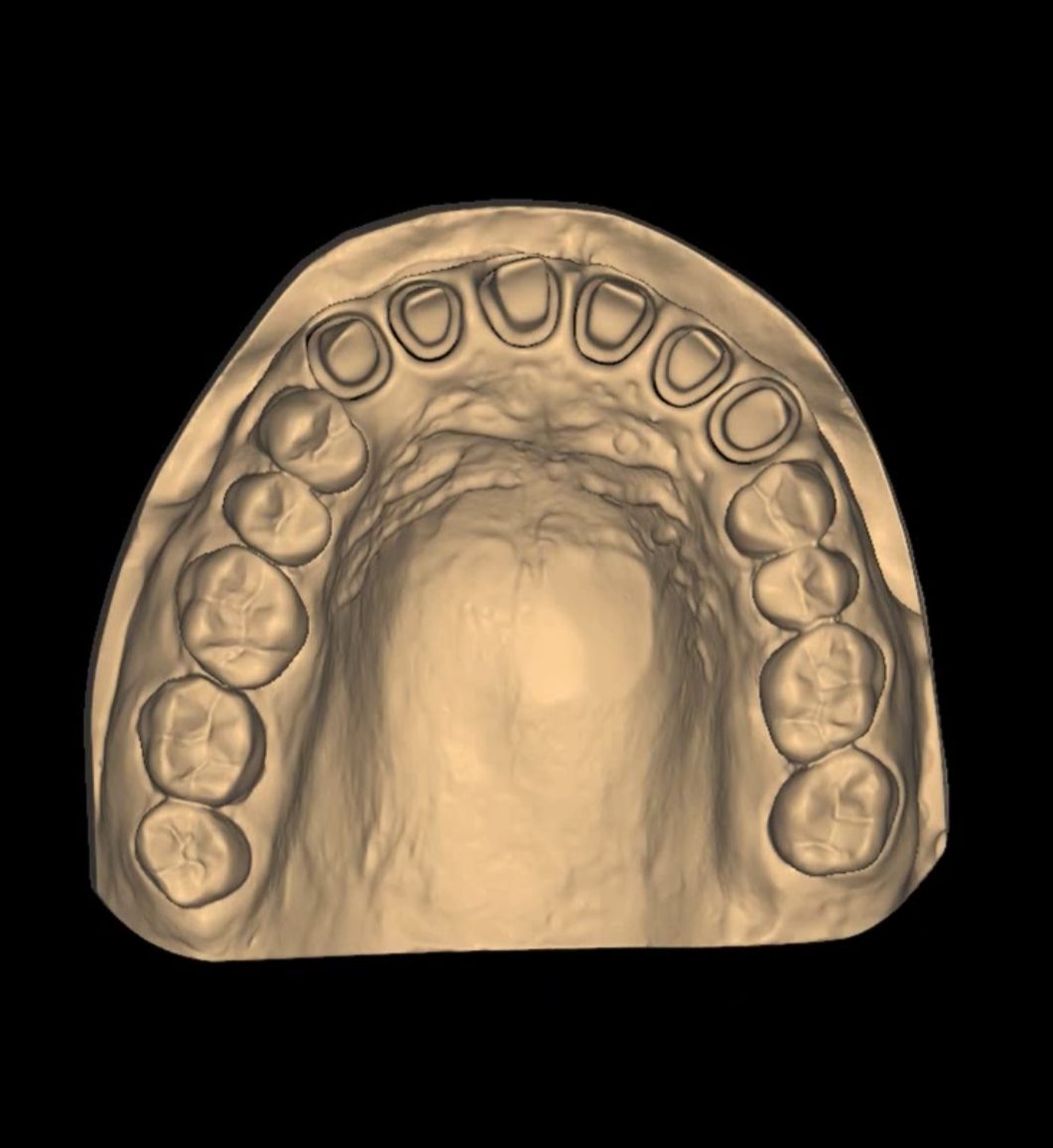 Prepared Teeth CAD design – real design case 5