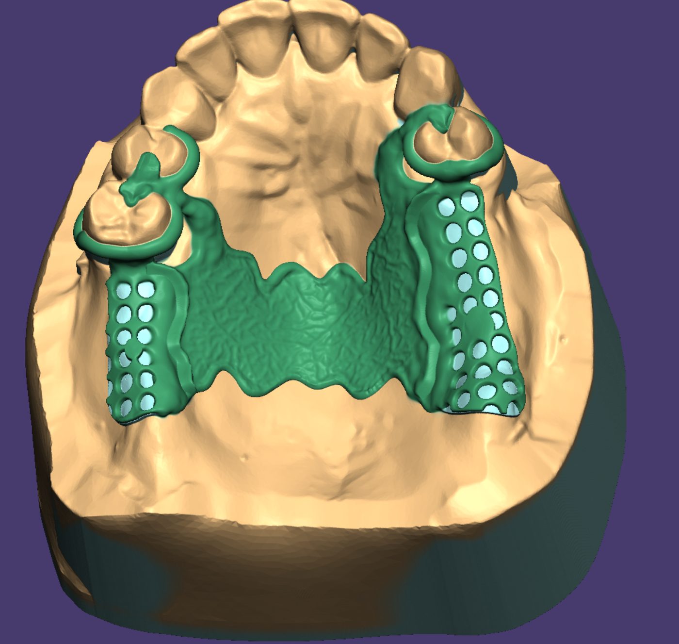 Upper framework with palatal strap – Removable Partial Dentures CAD design