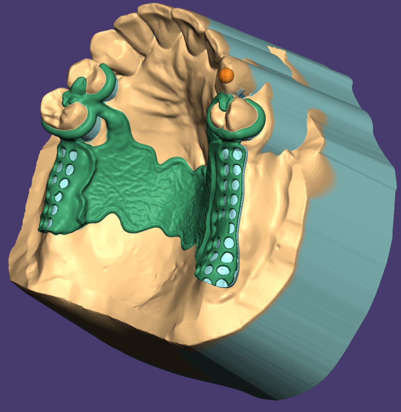 Removable Partial Dentures CAD design – real design case 5