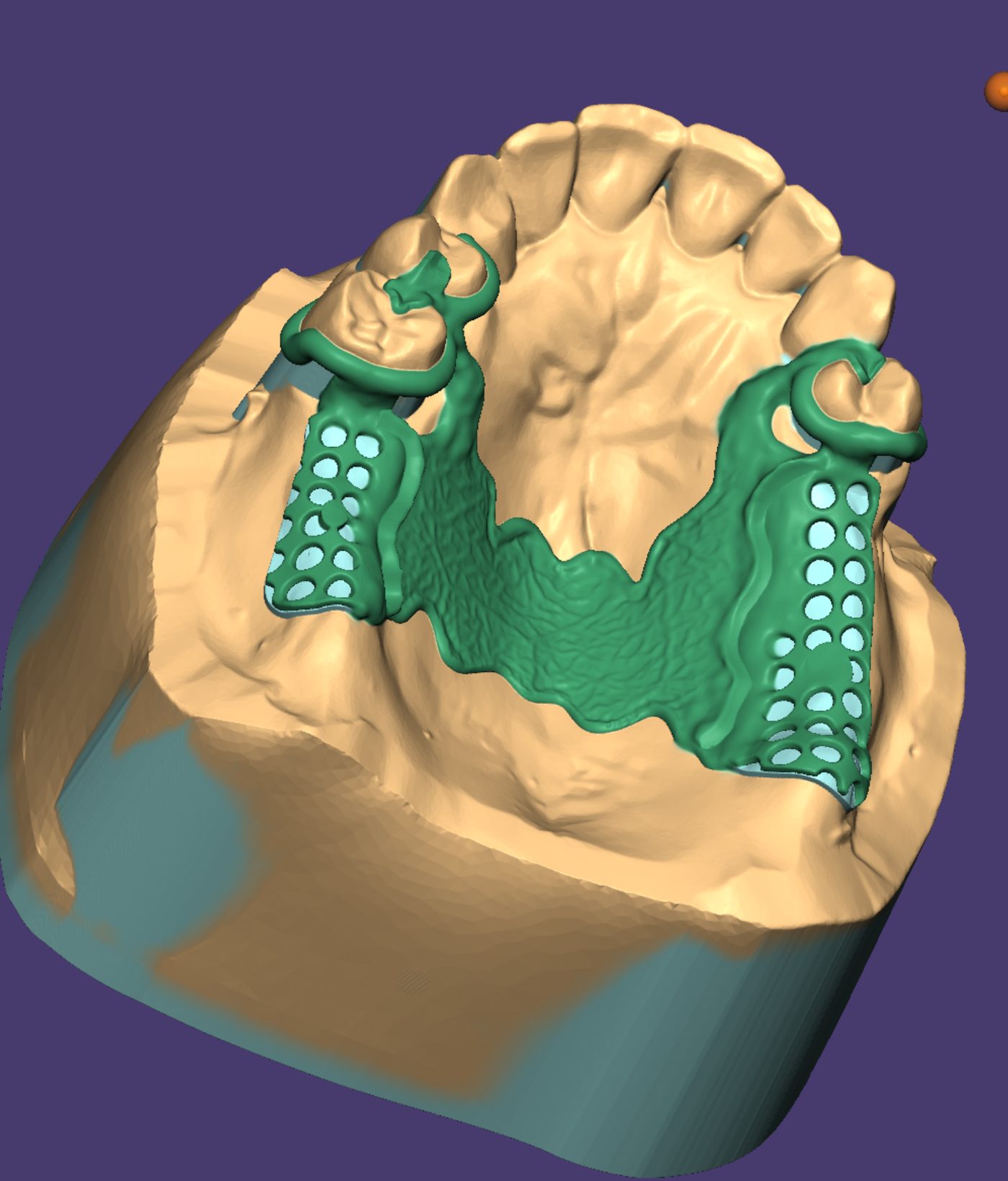 Removable Partial Dentures CAD design – real design case 6