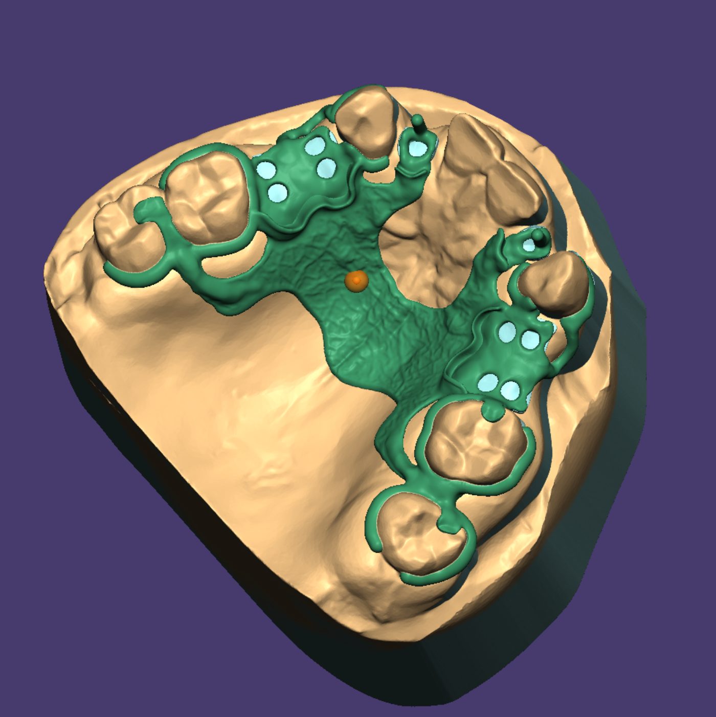 Removable Partial Dentures CAD design – real design case 8