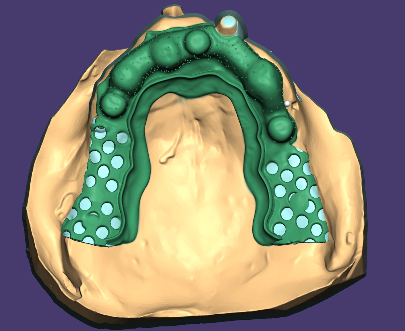 Removable Partial Dentures CAD design – real design case 9