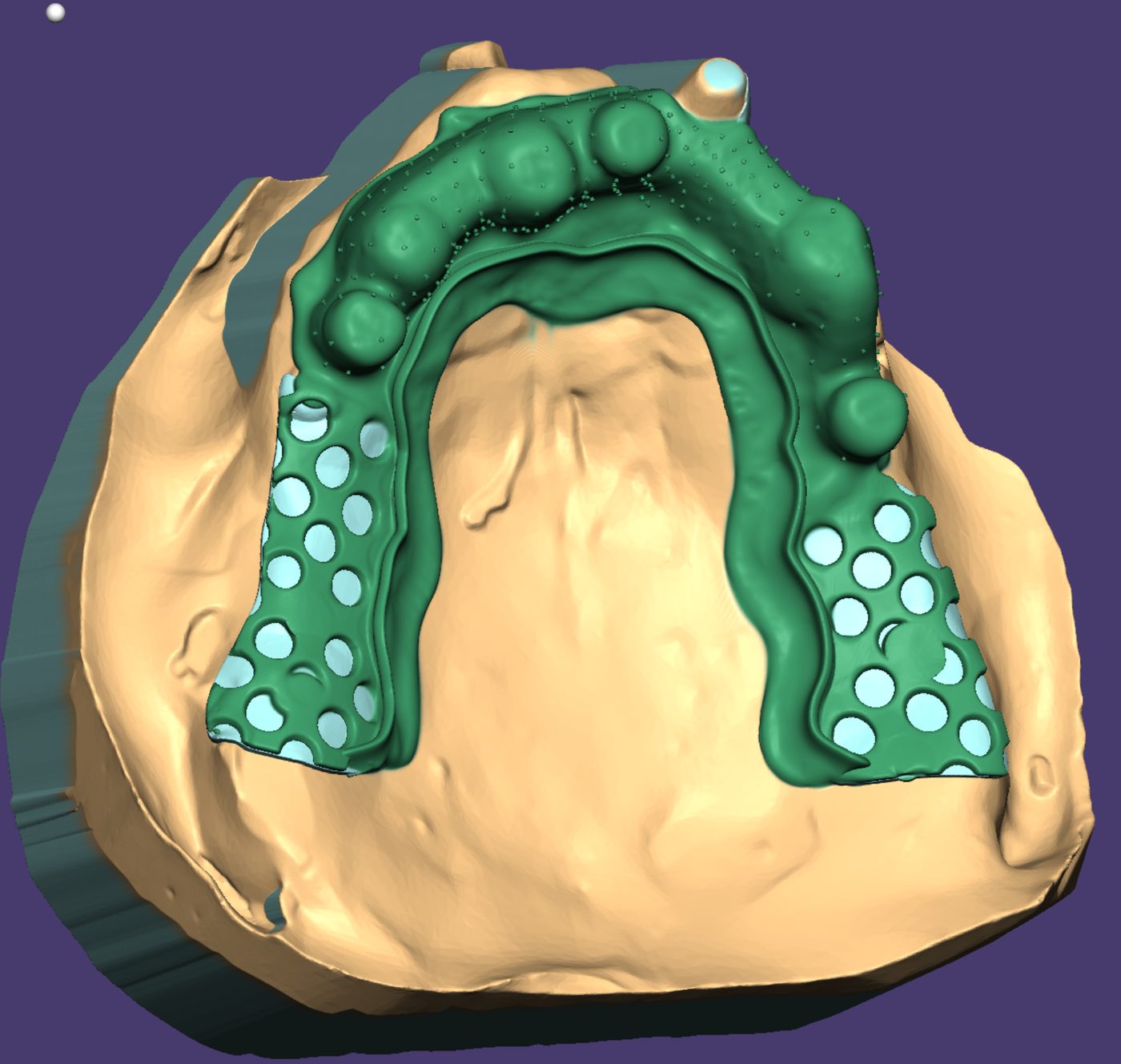 Lower framework with lingual bar – Removable Partial Dentures CAD design