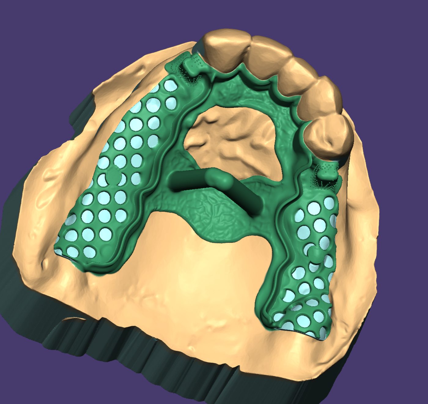 Removable Partial Dentures CAD design – real design case 11