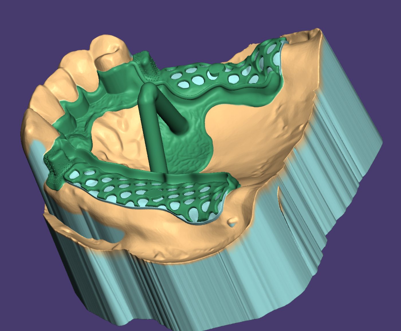 Removable Partial Dentures CAD design – real design case 12