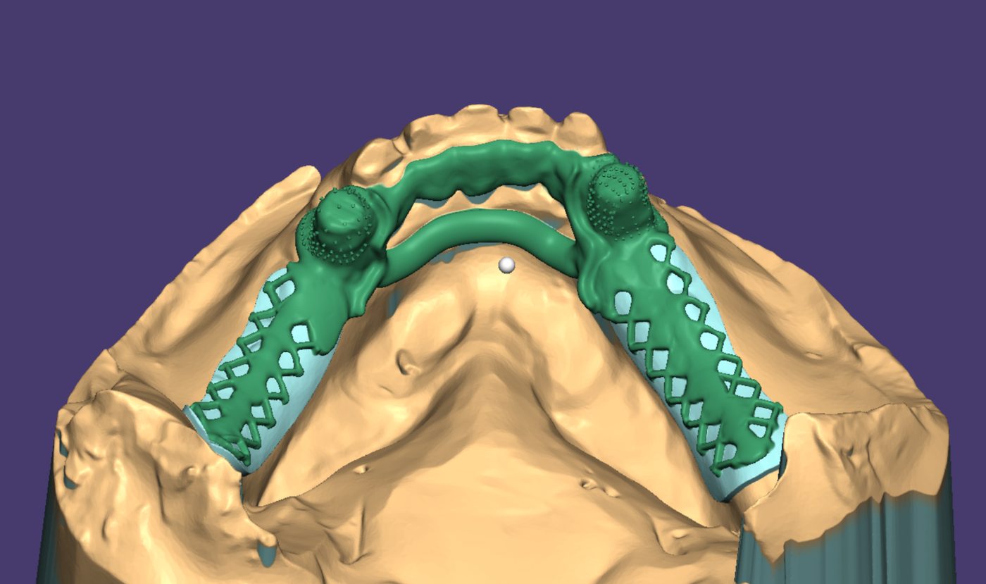 Removable Partial Dentures CAD design – real design case 13