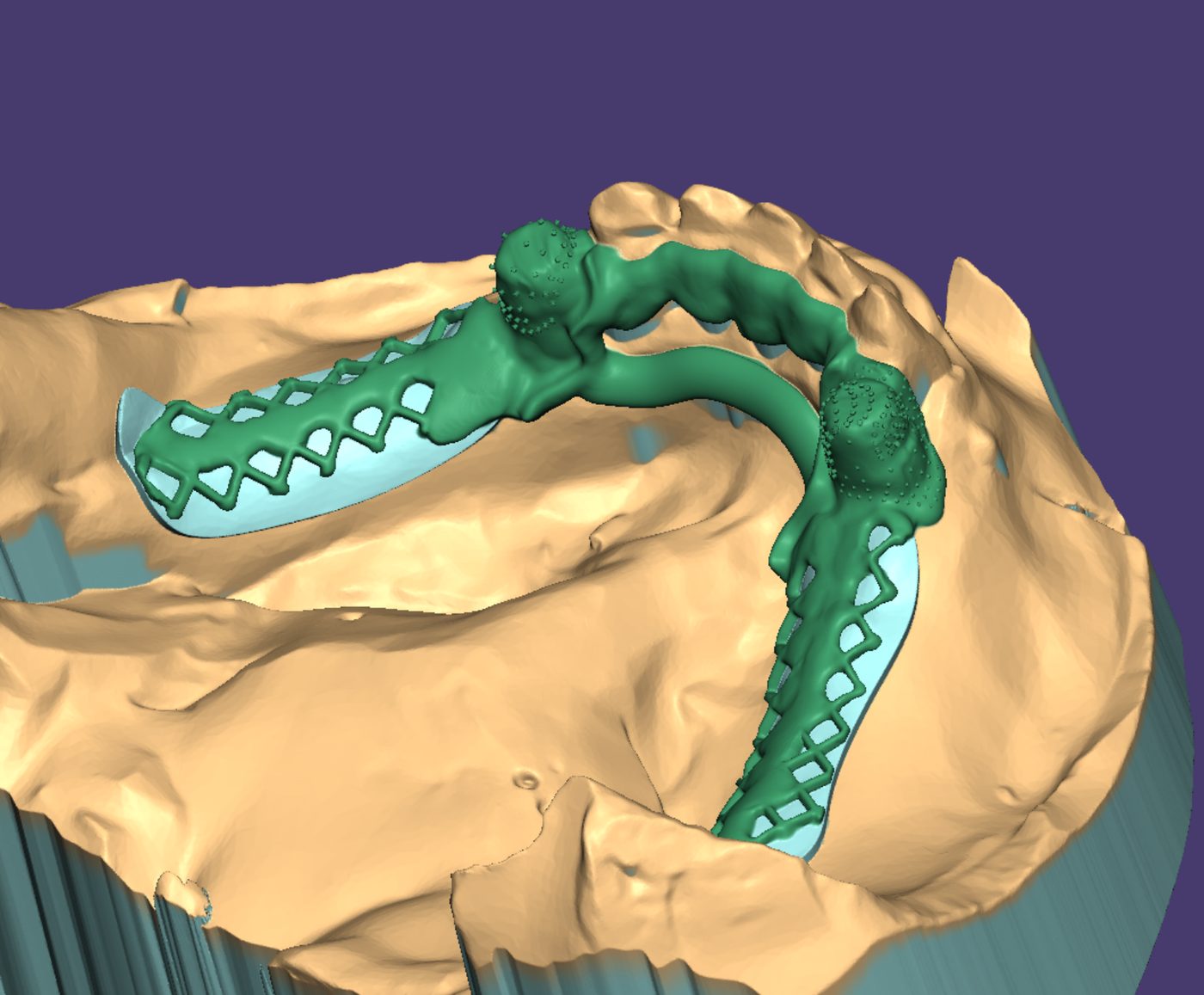 Removable Partial Dentures CAD design – real design case 14