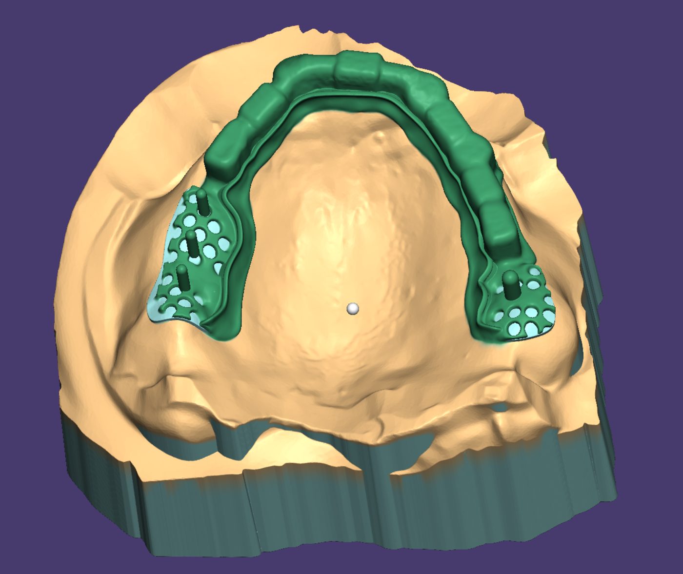 Removable Partial Dentures CAD design – real design case 15