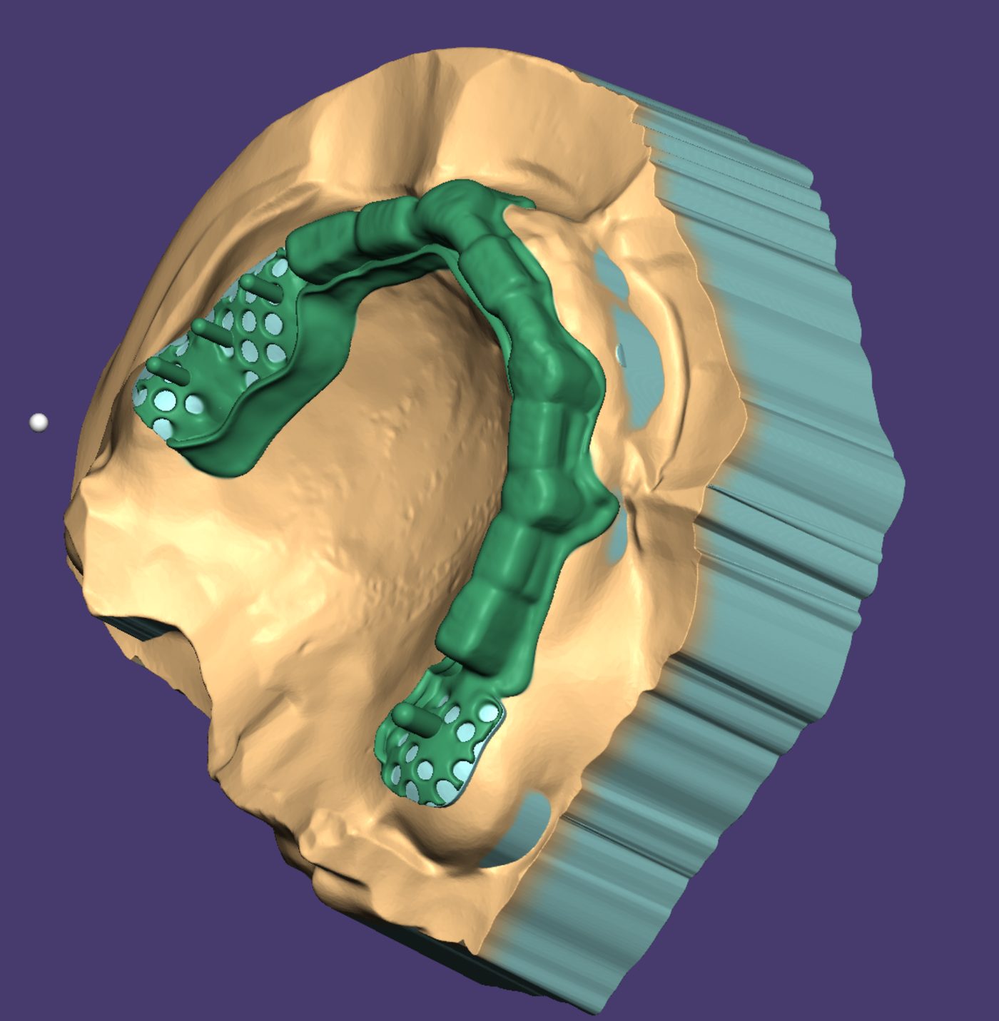 Removable Partial Dentures CAD design – real design case 16