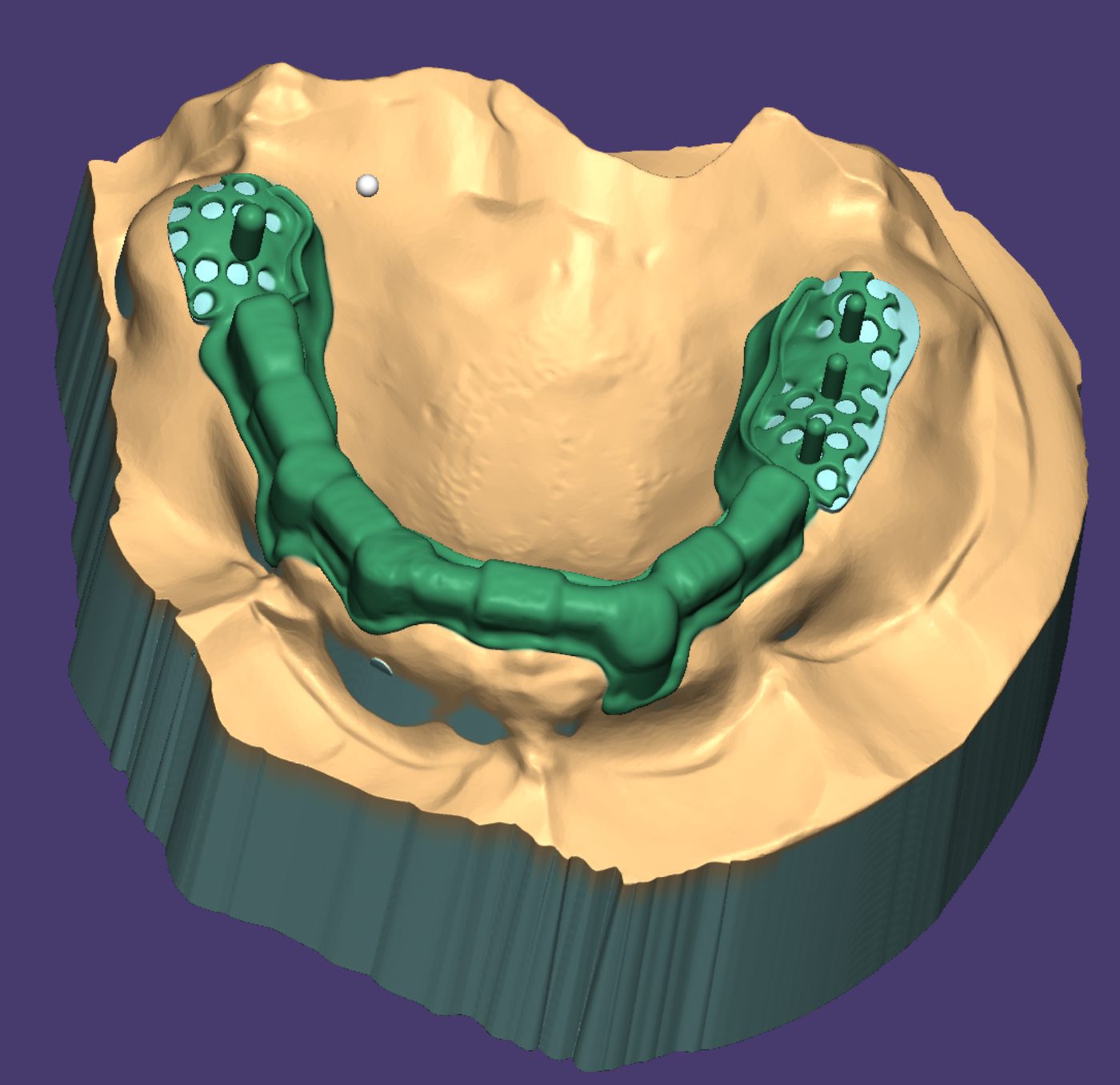 Removable Partial Dentures CAD design – real design case 17