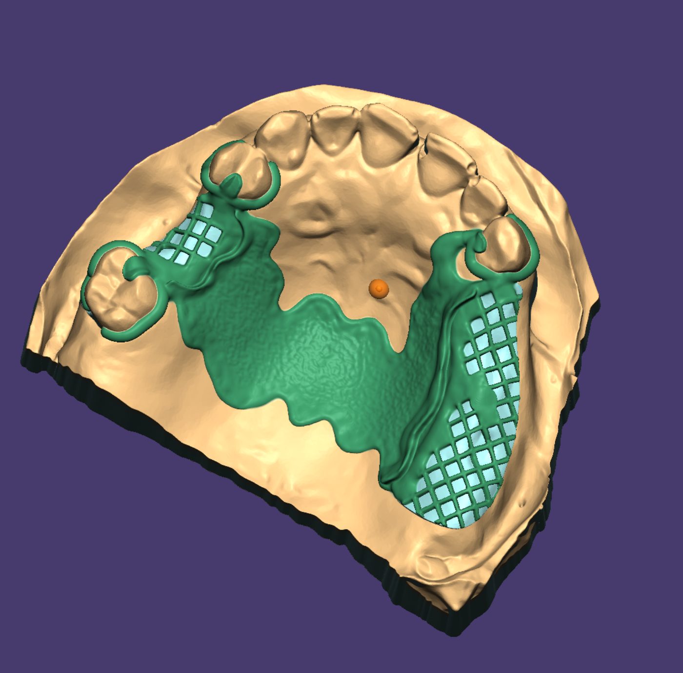 Removable Partial Dentures CAD design – real design case 18