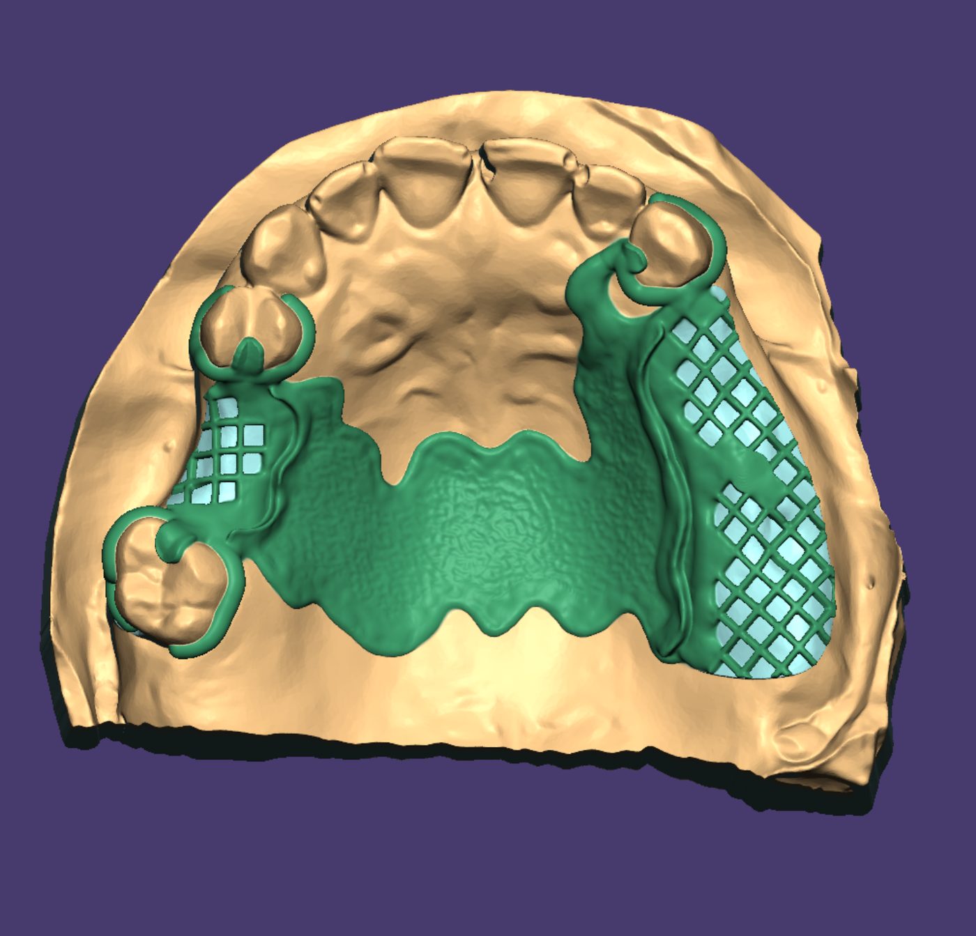 Removable Partial Dentures CAD design – real design case 19