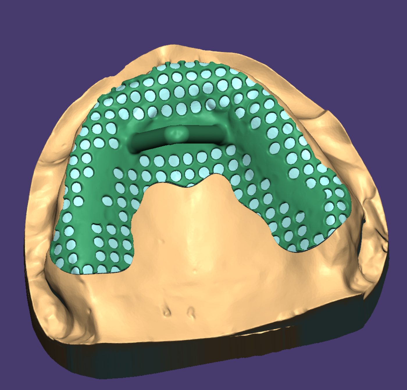 Removable Partial Dentures CAD design – real design case 20