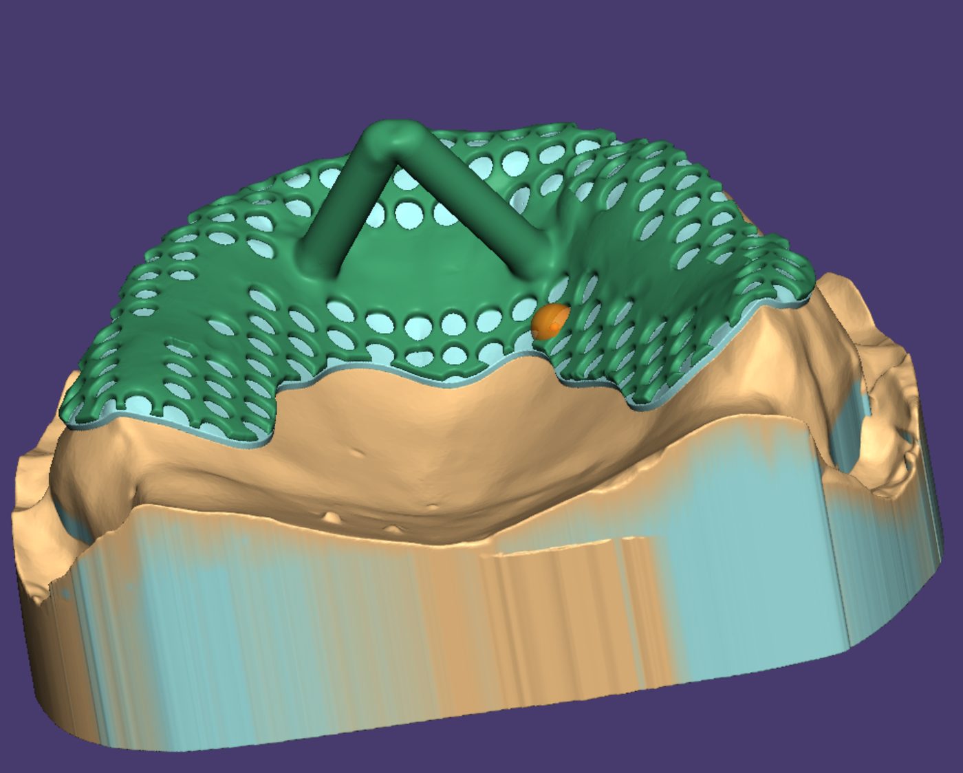 Removable Partial Dentures CAD design – real design case 21