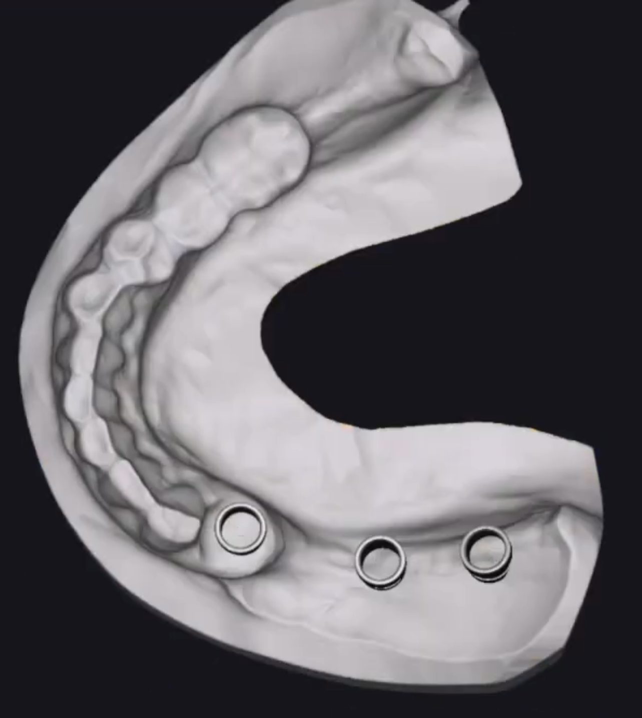 Final guide ready to print – Surgical Guides CAD design