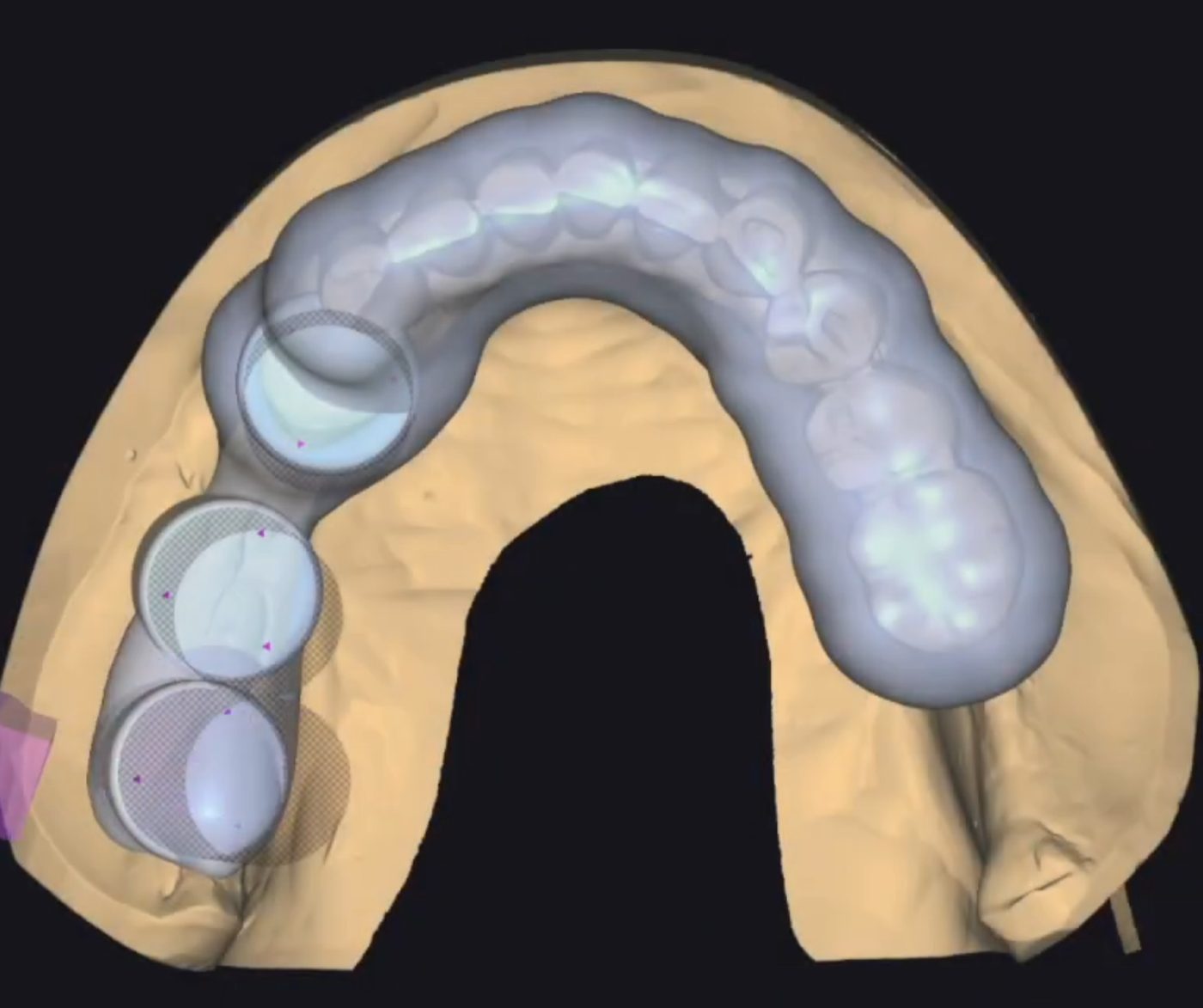 Surgical Guides CAD design – real design case 5
