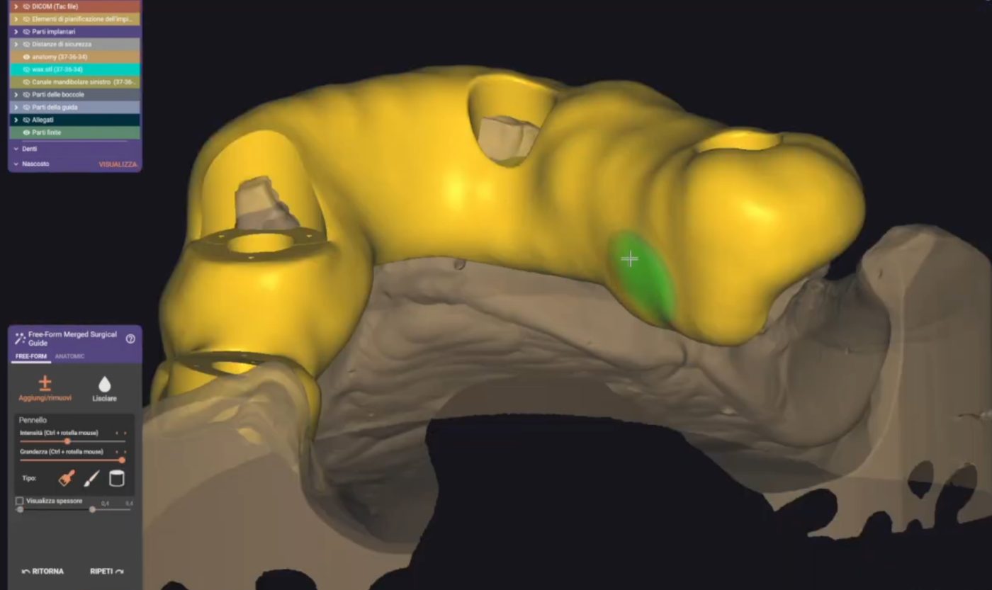 Surgical Guides CAD design – real design case 6